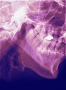 Normal lower jaw, X-ray